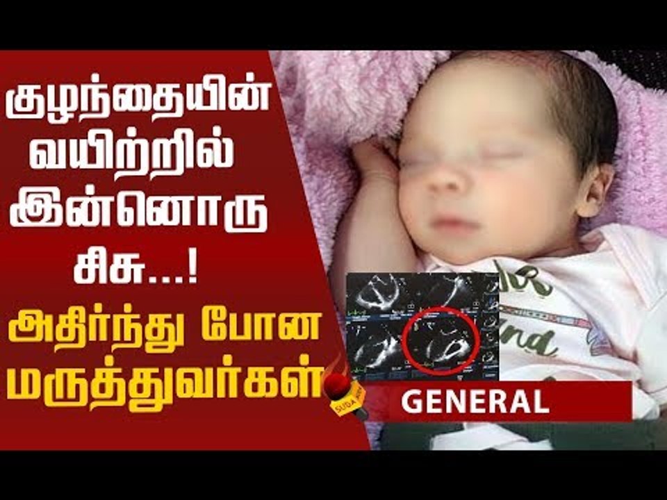 பெண்ணின் வயிற்றில் இருந்த குழந்தையின் வயிற்றுக்...