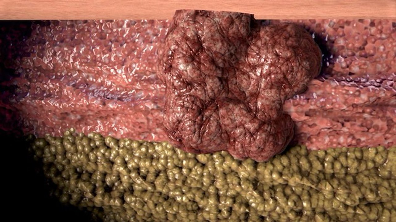 The top 3 most common forms of skin cancer