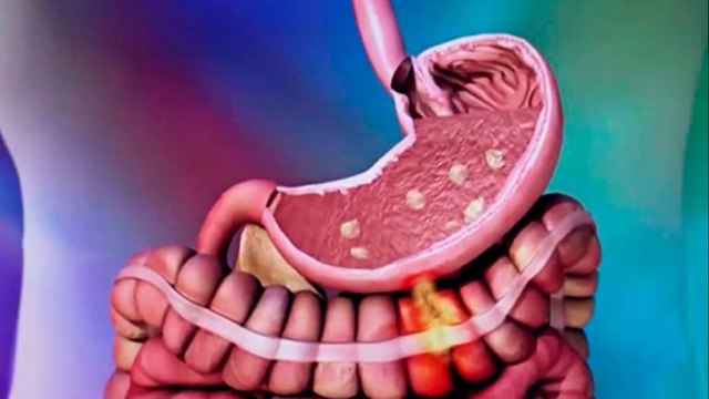 bd-causas-y-tratamientos-del-sangrado-digestivo-270521