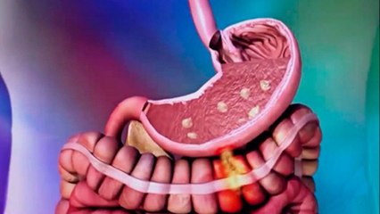 bd-causas-y-tratamientos-del-sangrado-digestivo-270521