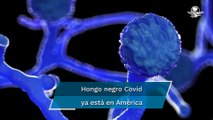 Detectan primer caso de hongo negro en paciente con Covid-19 en Uruguay