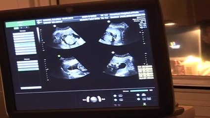 Les échographies de la grossesse en images