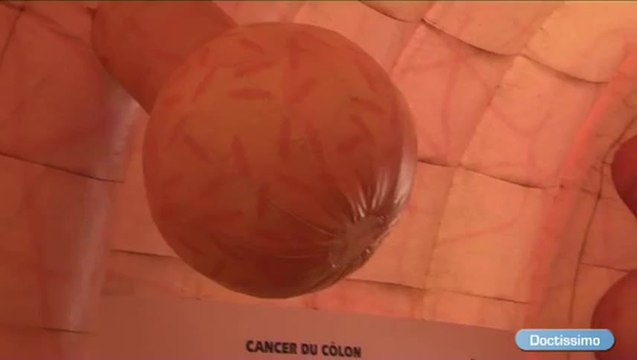 Un côlon géant pour nous sensibiliser au dépistage du cancer colorectal
