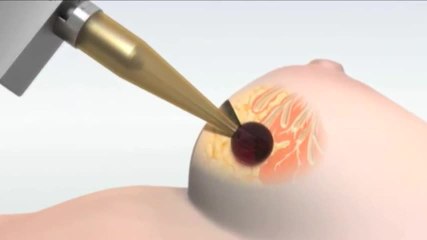 Intrabeam : chirurgie et radiothérapie en une seule séance
