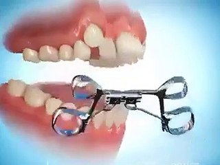 Diş teli dişleri nasıl düzeltiyor?