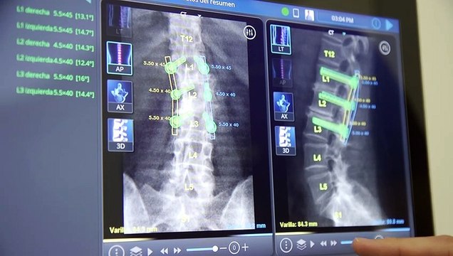 Quirónsalud Barcelona, primer hospital en España con un nuevo robot guiado para cirugía de columna