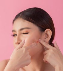 Cara Mengatasi Jerawat