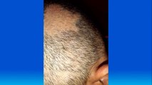 bd-causas-y-tratamientos-de-la-caida-del-cabello-310521