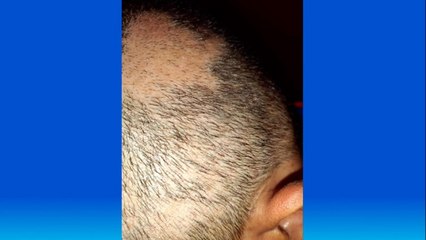 bd-causas-y-tratamientos-de-la-caida-del-cabello-310521