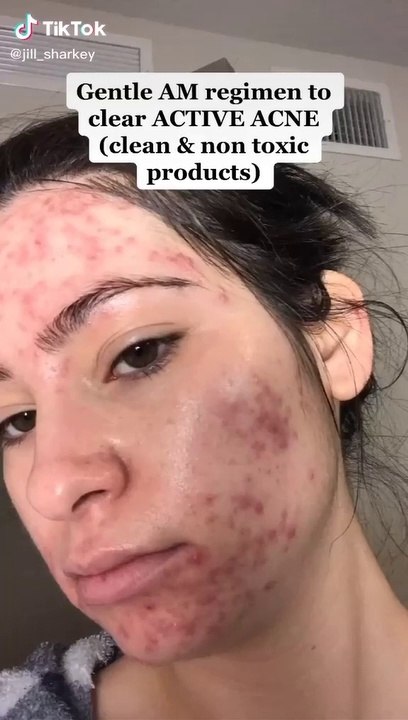 Best Acne Skincare Routine - video Dailymotion
