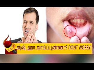அடிக்கடி வரும் வாய்ப்புண்ணை தவிர்க்க, தடுக்க எளிய வழிமுறைகள்!