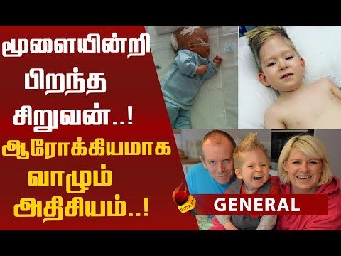 மூளையில்லாமல் பிறந்த குழந்தையின் வளர்ச்சியை பார்த்து அதிர்ந்துபோன மருத்துவர்கள் !