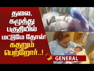 பிறந்த குழந்தையை பார்த்து அதிர்ந்துபோன மருத்துவர்கள்...!
