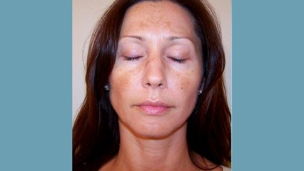 bd-tratamientos-para-melasma-o-paño-101120