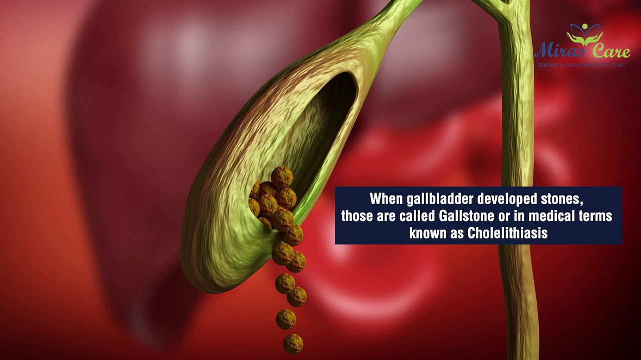 What are the gallstones-treatment,symptoms,diagnosis in Delhi NCR-Best Gallstone Surgeon Delhi India