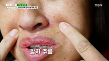 깊어지는 팔자 주름 때문에 죽겠어요...( T д T)