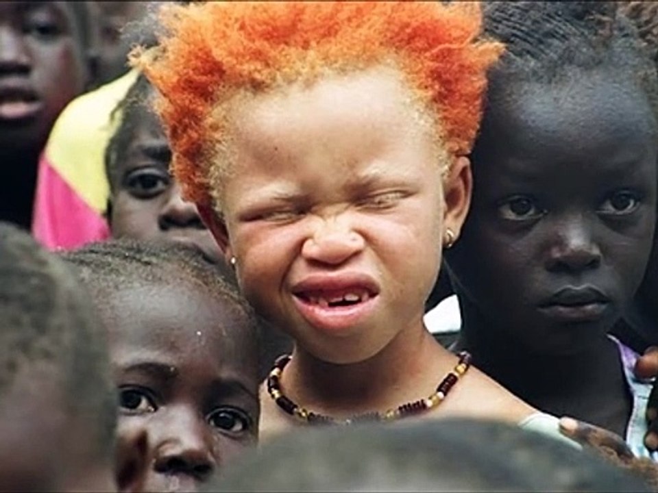 Black Albinos _ Albinism
