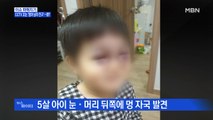 MBN 뉴스파이터-5살 아이 얼굴에 피멍…CCTV 끄는 '엄마 남자친구'?