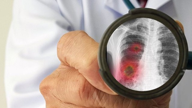 ‘Salgında akciğer kanseri tanısı alanların sayısı arttı’