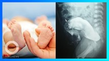 Lahir dengan Dua Penis, Bayi Ini Harus Jalani Serangkaian Prosedur Medis - TomoNews