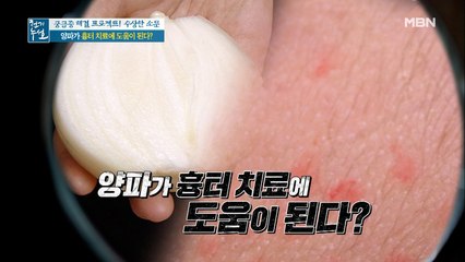 양파가 흉터 치료에 도움이 된다…???