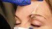 Nonsurgical Brow Lift Temporarily Raises Eyebrows
