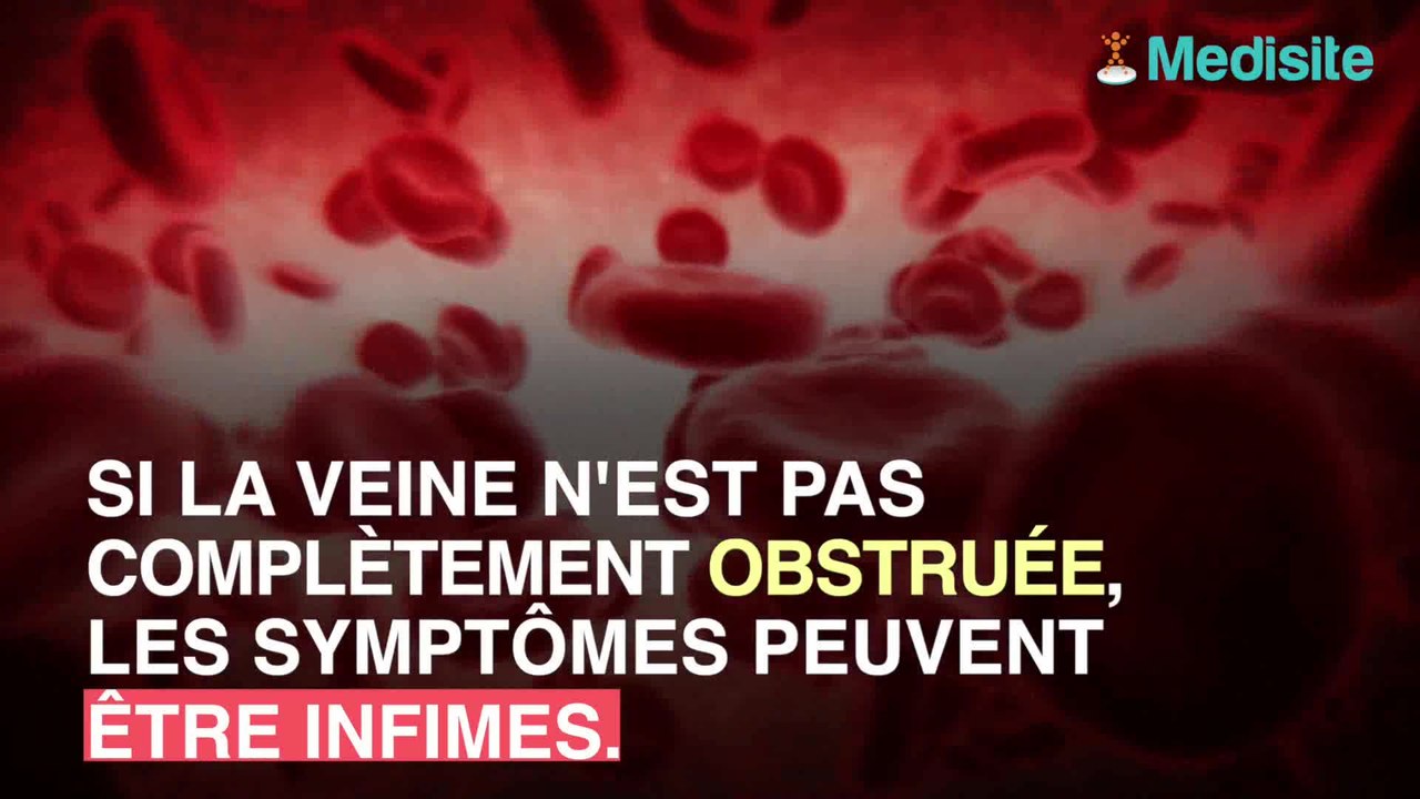 Phlébite : les signes qui ne trompent pas