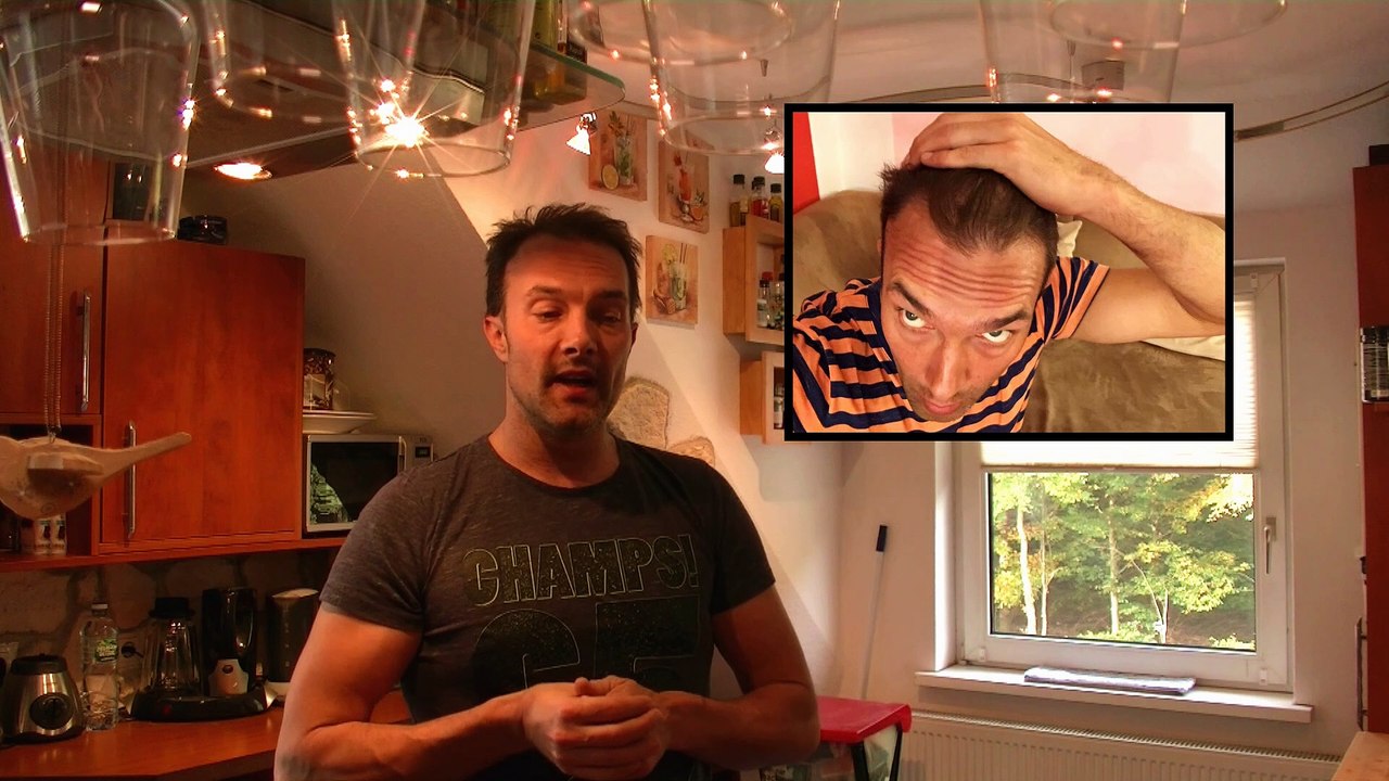 Teil 1 haartransplantation istanbul erfahrung bei medical exclusive istanbul türkei