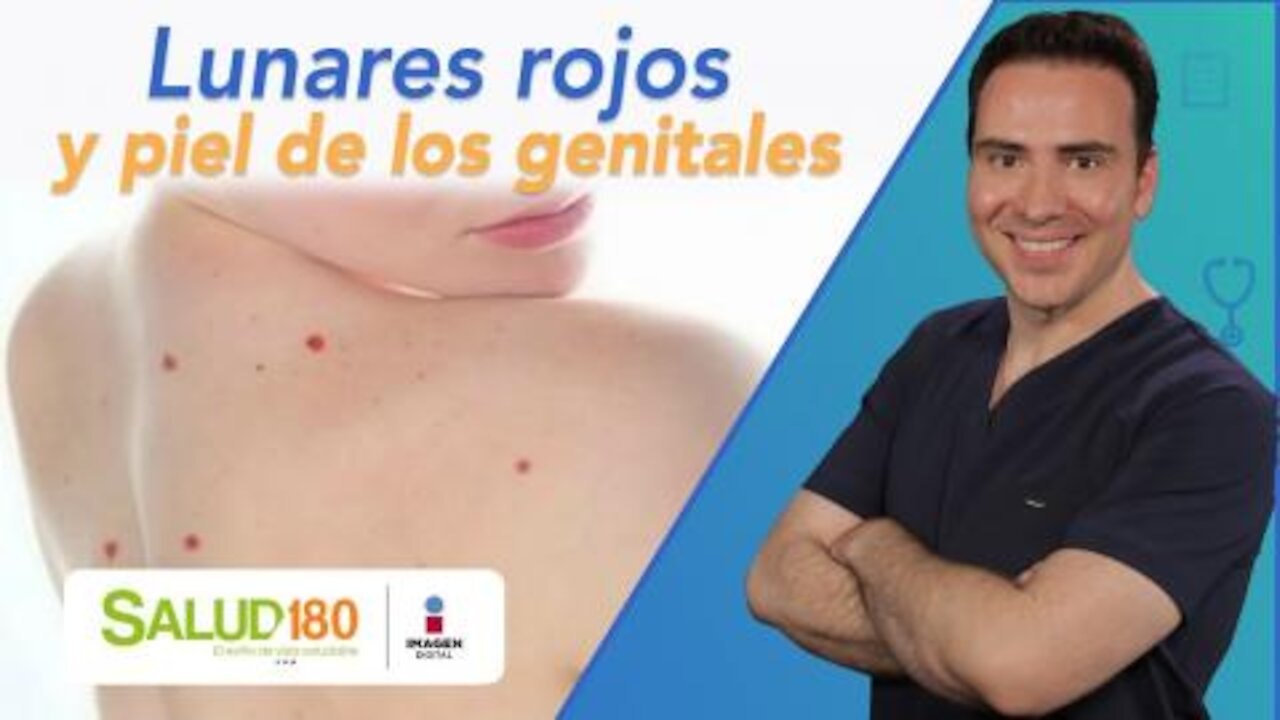 Dr. Salud | Lunares rojos y piel de los genitales | Salud 180