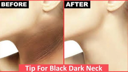 Tip For Black Dark Neck _ Shah Nazir (Herbalist)