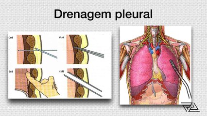 ATLS 10ª edição - Aula 5 - Trauma torácico