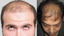 30 साल की उम्र में आदमी के बाल क्यों झड़ते है | Hair Fall At 30 | Men Hair Fall | Boldsky
