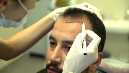 Clinicexpert ile DHI Pro Saç Ekimi