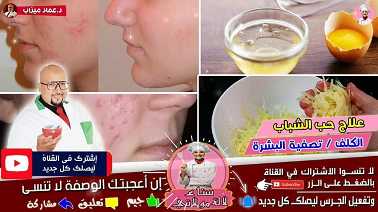وصفة طبيعية لعلاج حب الشباب والكلف وتصفية البشرة من عند الدكتور عماد ميزاب