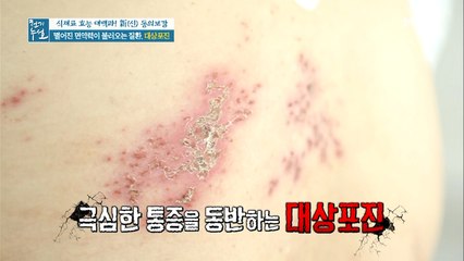 떨어진 면역력이 불러오는 질환 [대상포진]