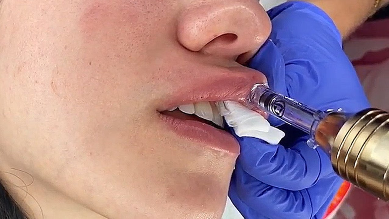 Needle-less lip fillers give you fuller lips instantly