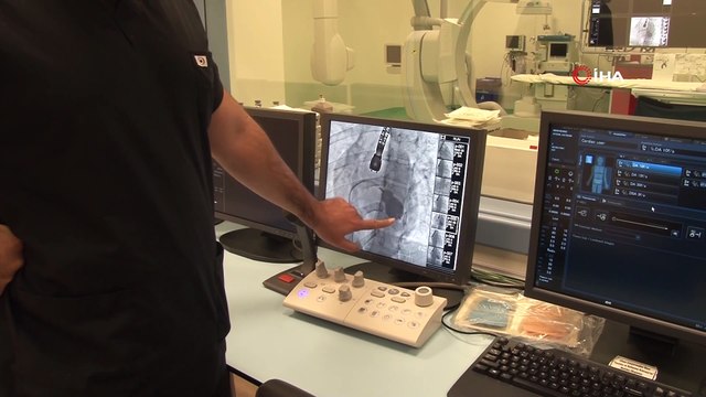 Mitral balon operasyonu adım adım kaydedildi