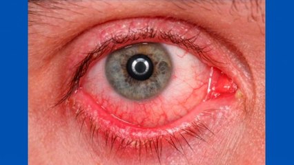 bd-que-son-los-blefaritis-141220