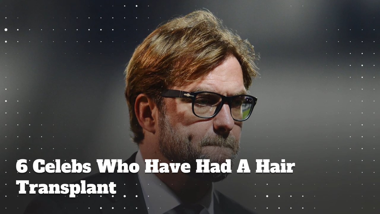 6 Celebs Who Have Had A Hair Transplant