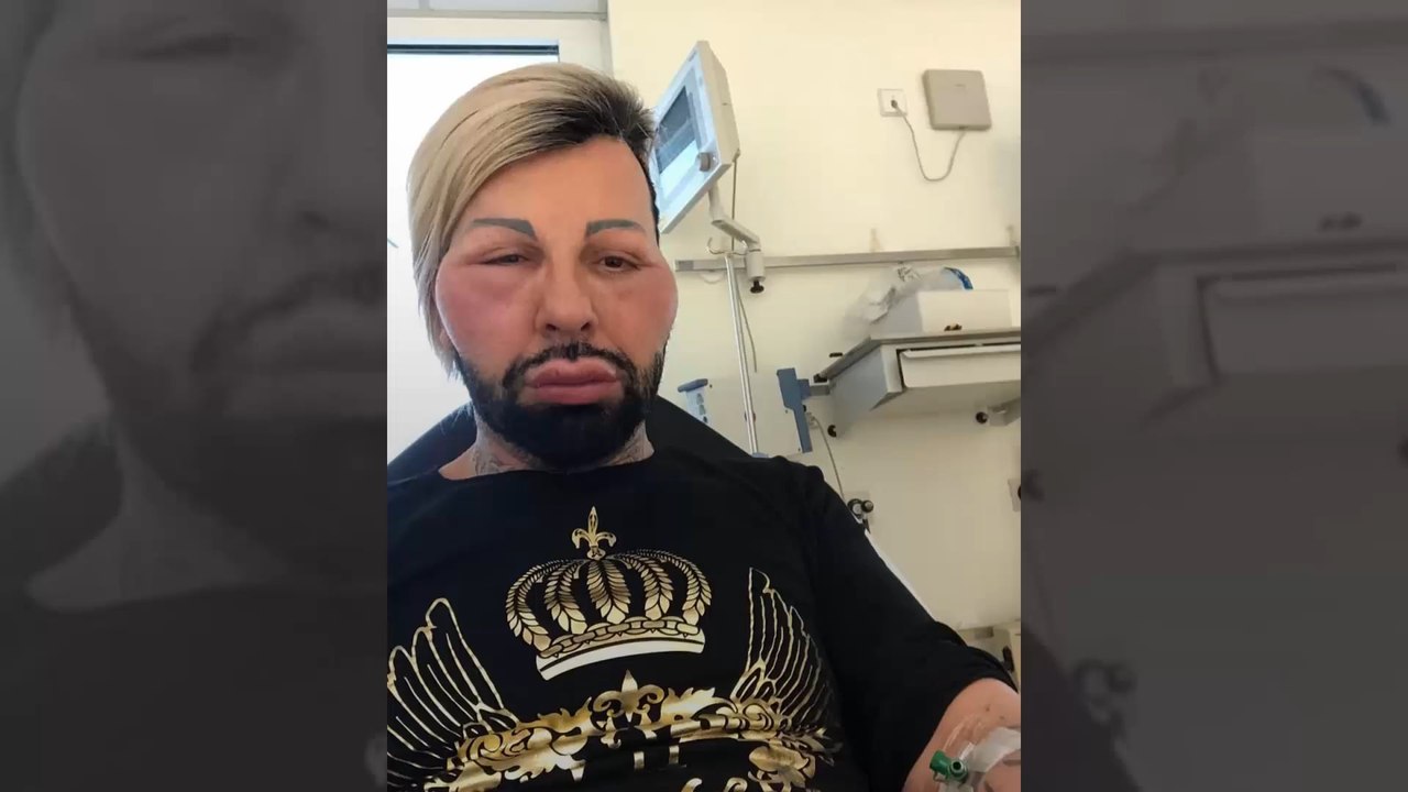 Harald Glööckler schockiert mit neuem Bild