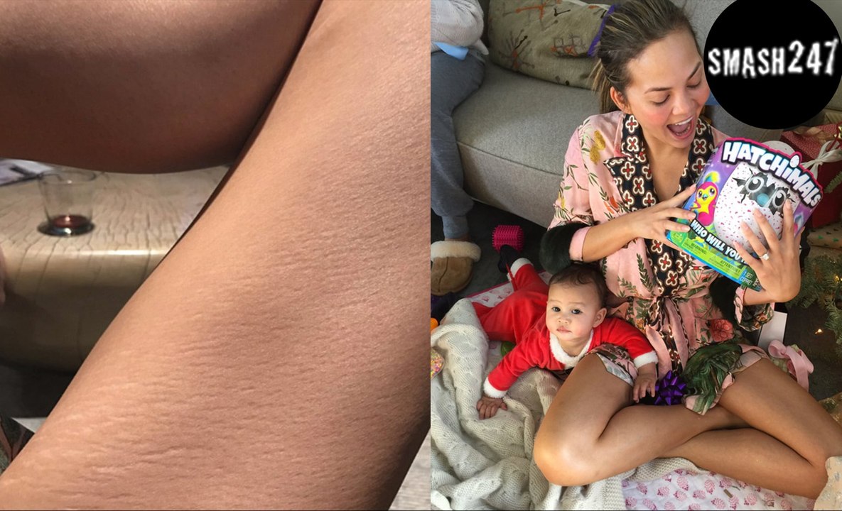 Chrissy teigen: bereut sie ihr ehrliches dehnungsstreifen-foto?