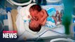 Yemeni conjoined twins await surgery amid poor medical resources in the country