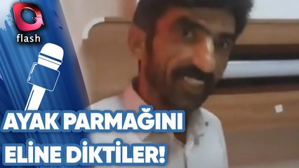 Ayak Parmağı Eline Dikildi!