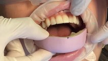 Watch how temporary veneers instantly transform smiles