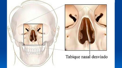 bd-causas-y-tratamientos-del-tabique-desviado-28122