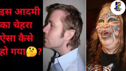 इस आदमी का चेहरा ऐसा कैसे हो गया?Dennis Aavner story