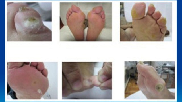 bd-alternativas-de-tratamientos-para-callos-dolorosos-301220