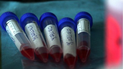 New Research Studies Covid-19 Brain Damage