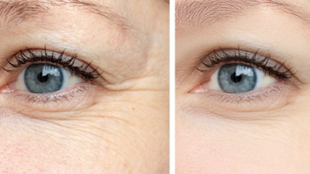 आंखों के आस पास हो गई हैं झुर्रियां तो अपनाएं ये टिप्‍स । Under Eye Wrinkle Home Remedy । Boldsky