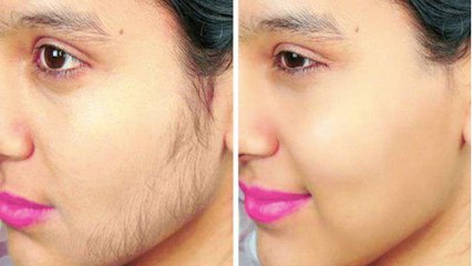 बिना दर्द और सस्ते में पाए अनचाहे बालों से छुटकारा, सिर्फ 1 फेसपैक का कर लें इस्तेमाल । Boldsky